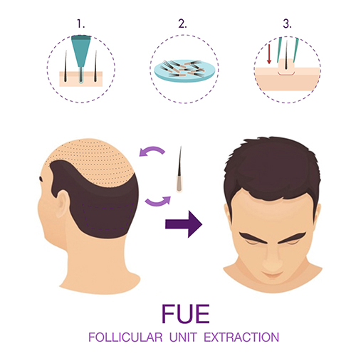 Follicular unit excision