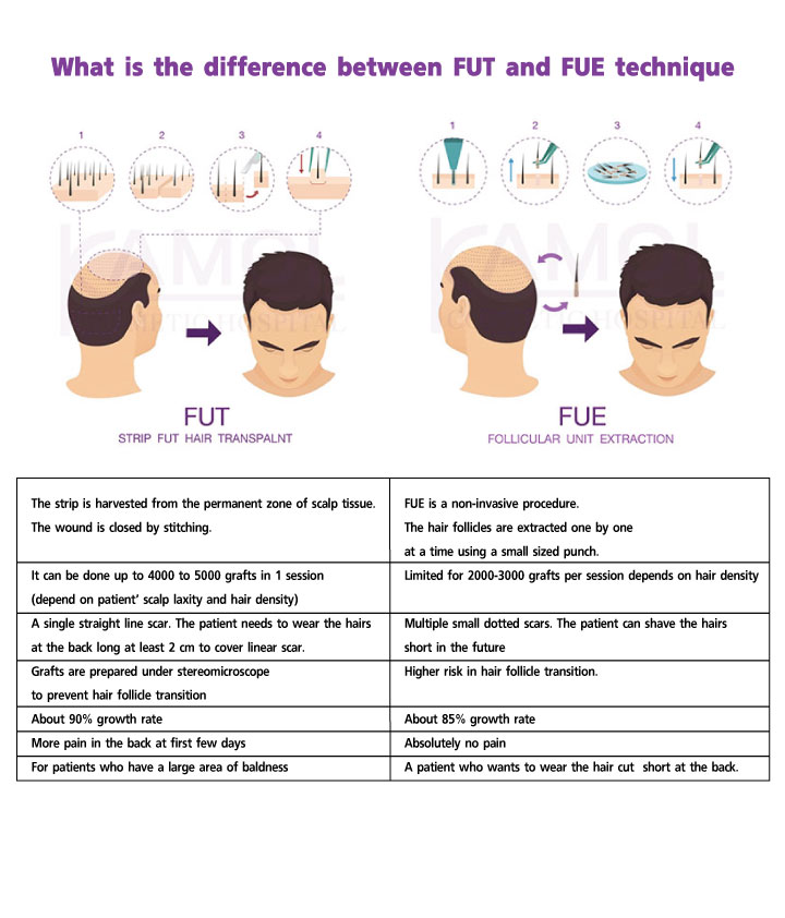 Strip Fut Hair Transpalnt (FUTX and Follicular Unit Extraction (FUE)