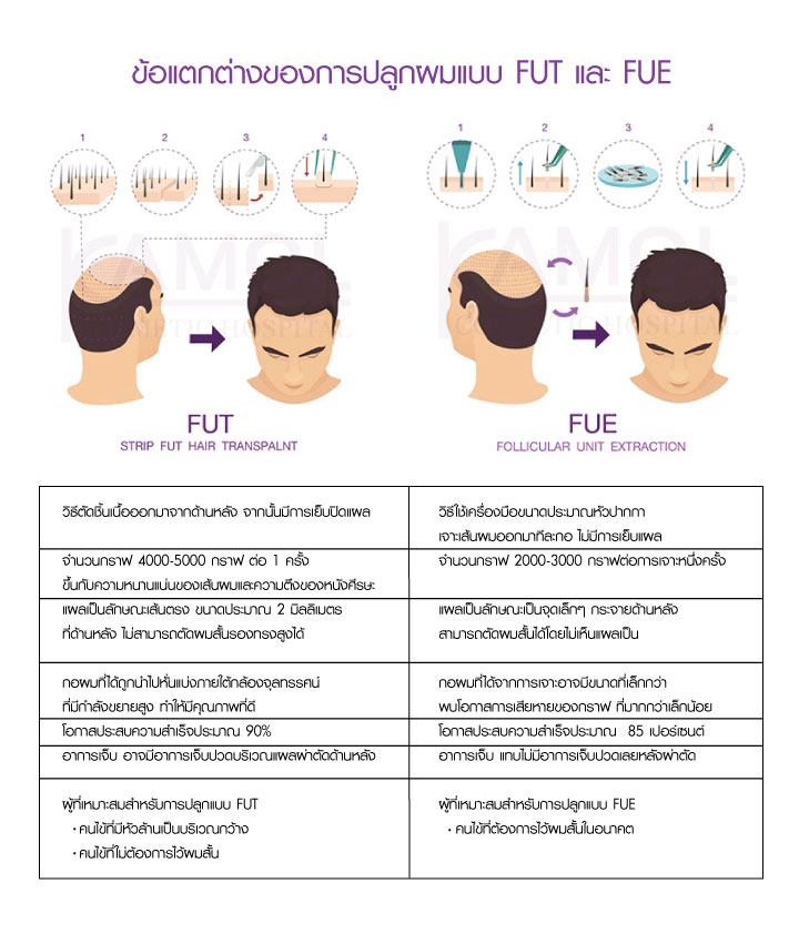 ข้อแตกต่างของการปลูกผมแบบ FUT และ FUE