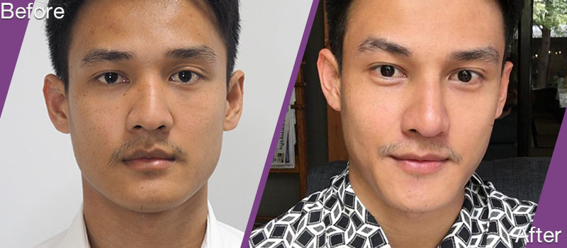 before and after Rhinoplasty for International look  