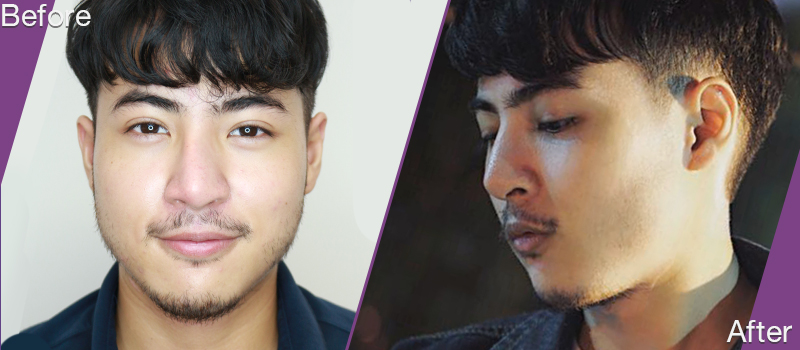 before and after Rhinoplasty 