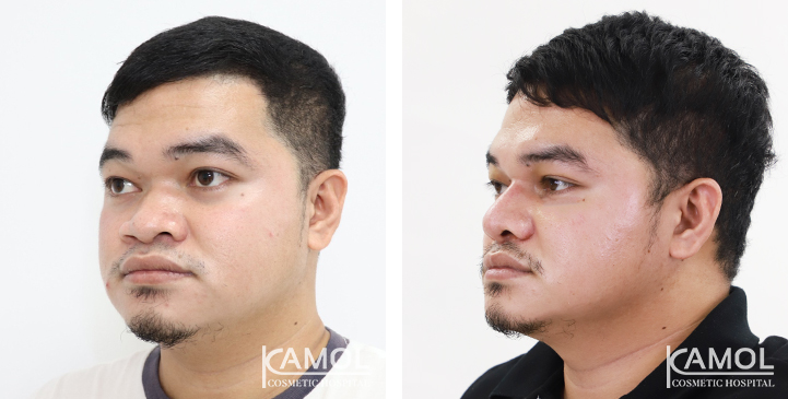 Before  & After Rhinoplasty