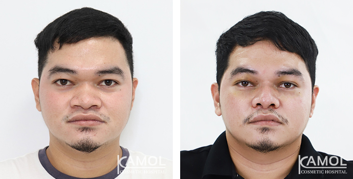 Before  & After Rhinoplasty