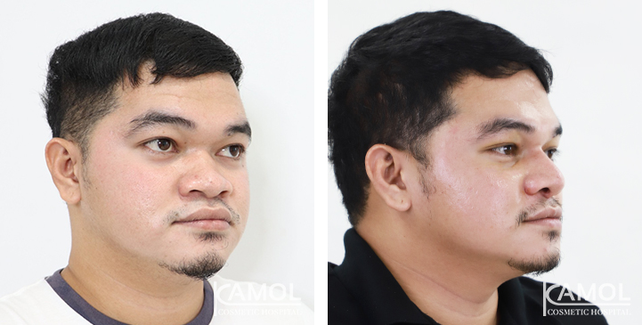 Before  & After Rhinoplasty