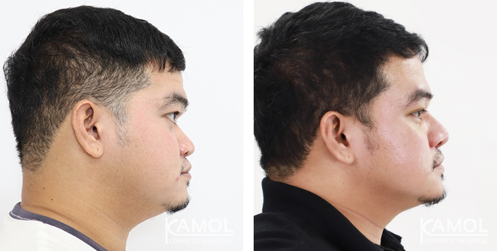 Before  & After Rhinoplasty