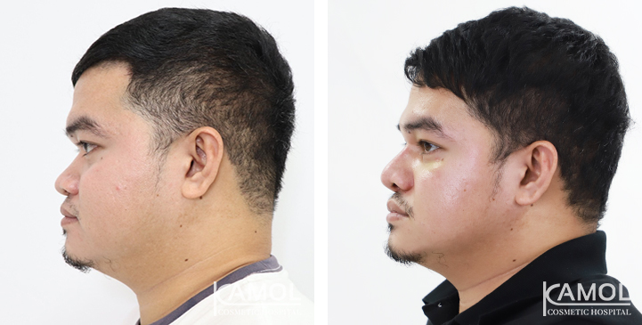 Before  & After Rhinoplasty