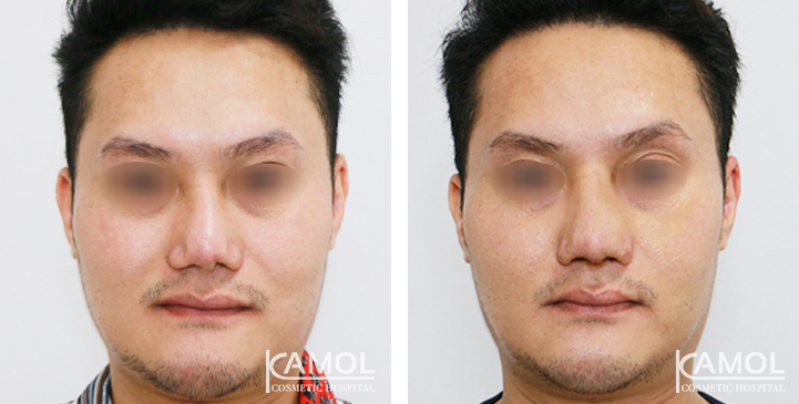 Before  & After Rhinoplasty