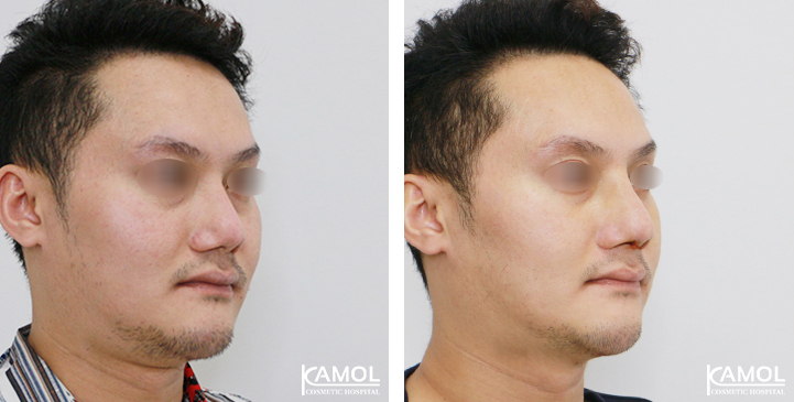 Before  & After Rhinoplasty