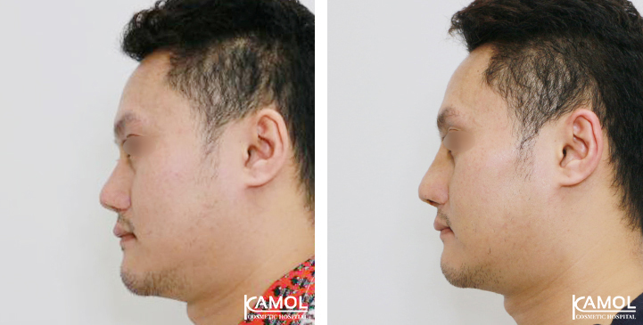 Before  & After Rhinoplasty