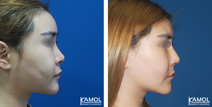 Before  & After Rhinoplasty