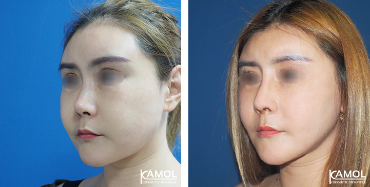 Before  & After Rhinoplasty