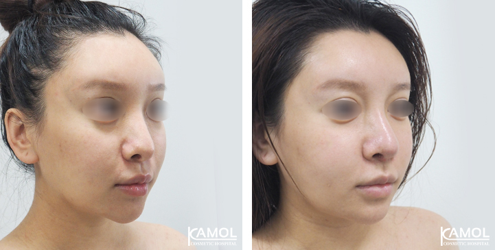 Before  & After Rhinoplasty