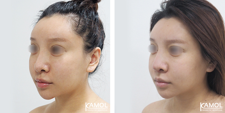 Before  & After Rhinoplasty