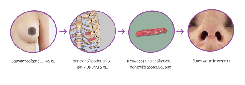 เทคนิคการเสริมจมูกด้วยกระดูกซี่โครง ของโรงพยาบาลศัลยกรรมตกแต่งกมล