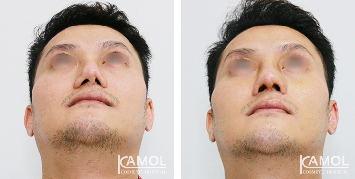 Before  & After Rhinoplasty