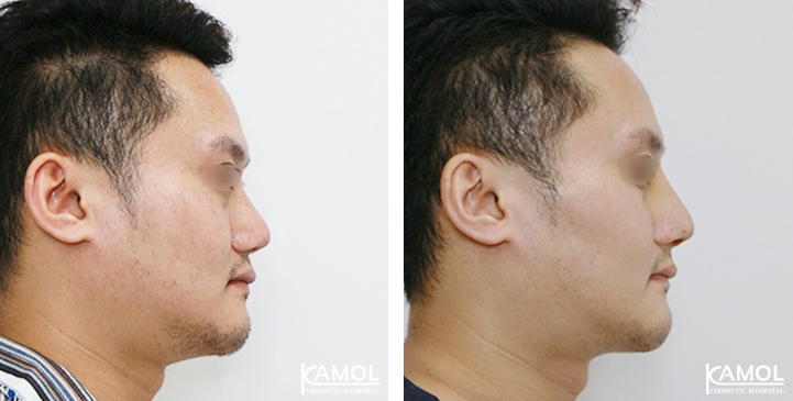 Before  & After Rhinoplasty