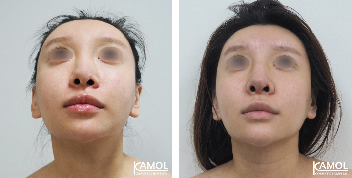 Before  & After Rhinoplasty