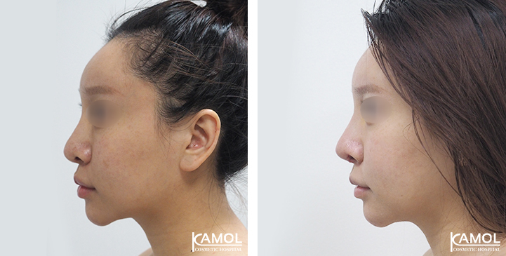 Before  & After Rhinoplasty