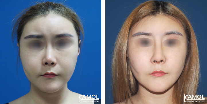 Before  & After Rhinoplasty