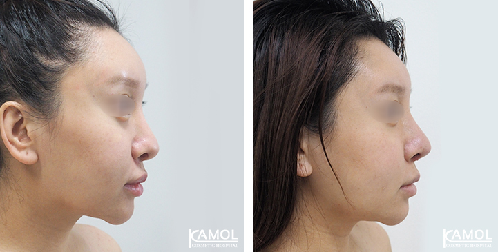 Before  & After Rhinoplasty