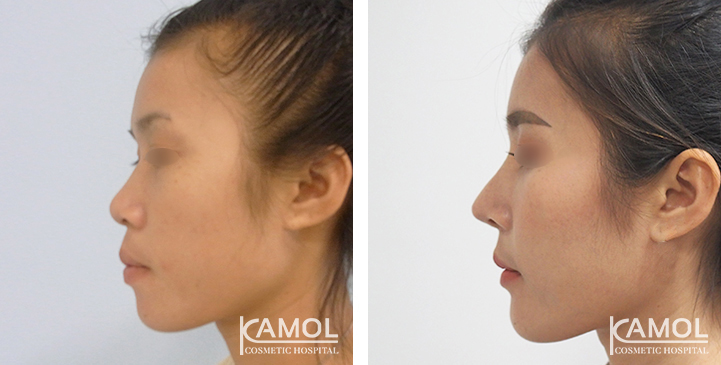 Before  & After Rhinoplasty