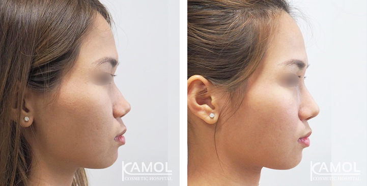 Before  & After Rhinoplasty