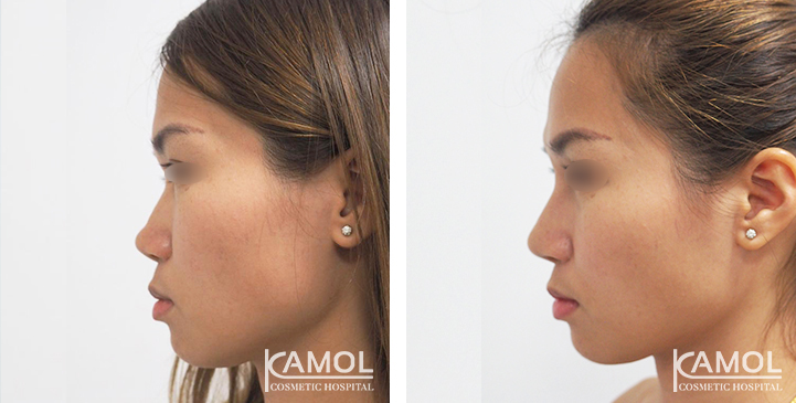 Before  & After Rhinoplasty