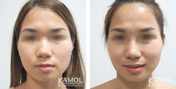 Before  & After Rhinoplasty