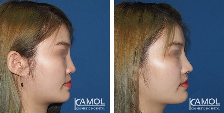 Before  & After Rhinoplasty