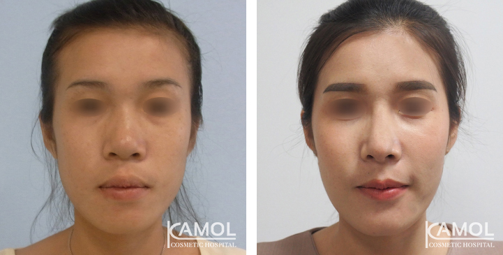 Before  & After Rhinoplasty