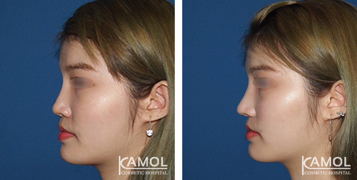 Before  & After Rhinoplasty