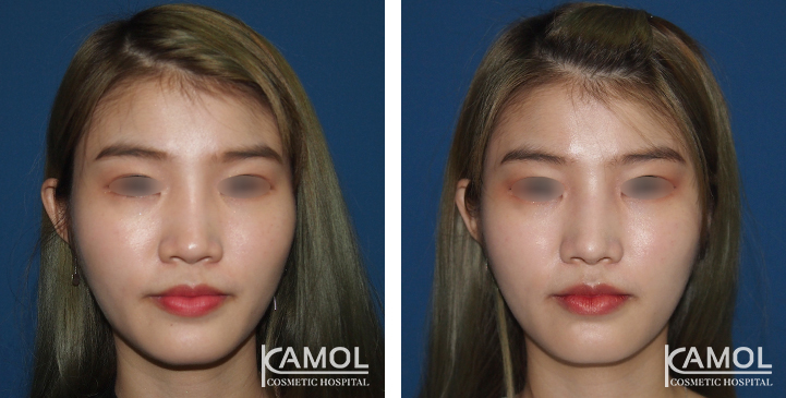 Before  & After Rhinoplasty