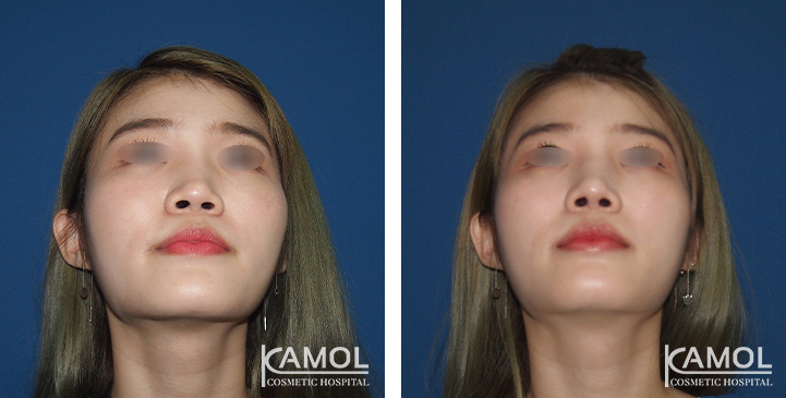 Before  & After Rhinoplasty