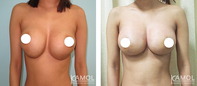 Before and After Reconstruction surgery to fix capsular contracture