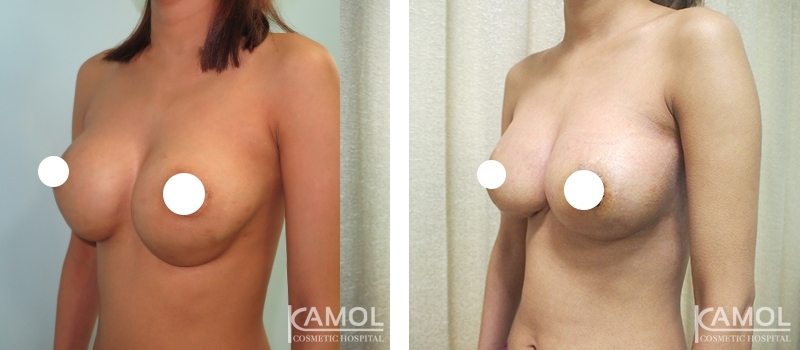 Before and After Reconstruction surgery to fix capsular contracture