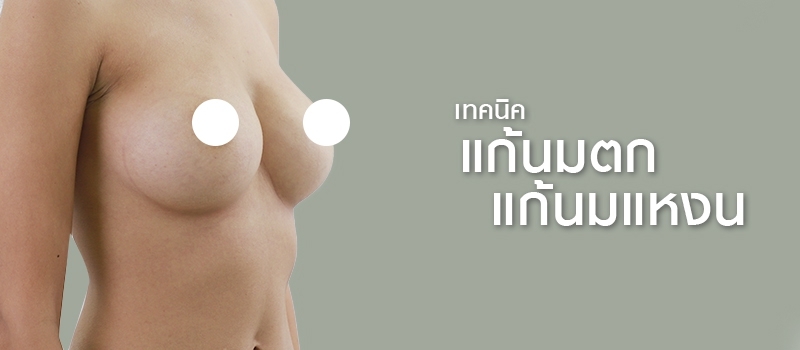 ผ่าตัดแก้ไขนมตก (Bottoming out of breast)