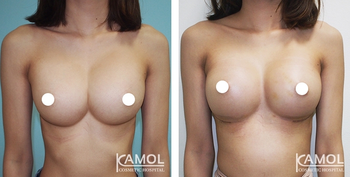 Before and After Reconstruction surgery to fix symmastia uniboob