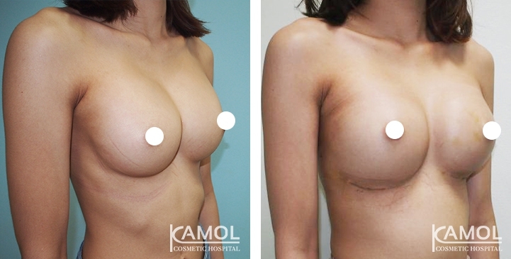 Before and After Reconstruction surgery to fix symmastia uniboob