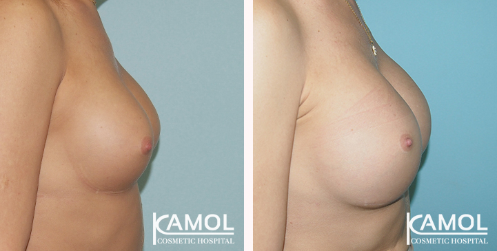 Before and After Reconstruction surgery to fix symmastia uniboob