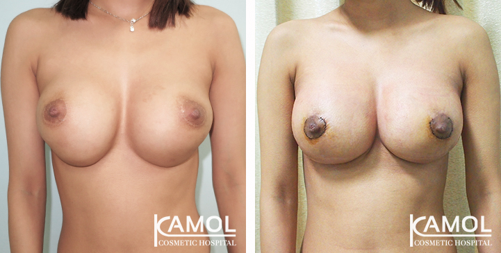 Before and After Reconstruction surgery to fix symmastia uniboob