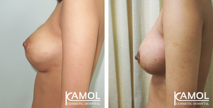 Before and After Reconstruction surgery to fix symmastia uniboob