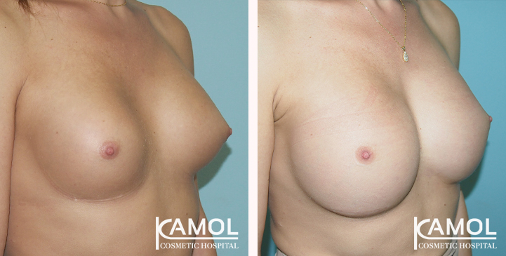 Before and After Reconstruction surgery to fix symmastia uniboob