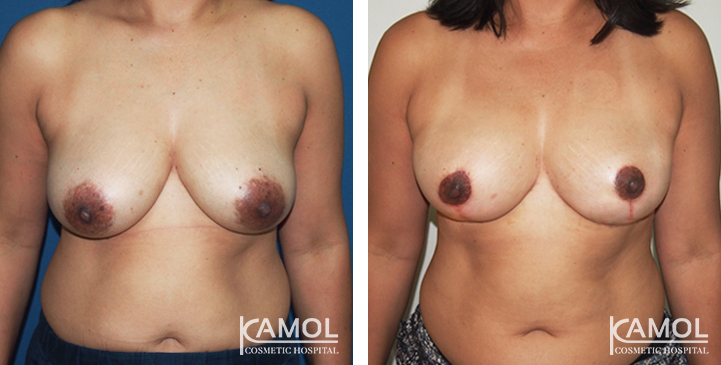 Breast Reduction