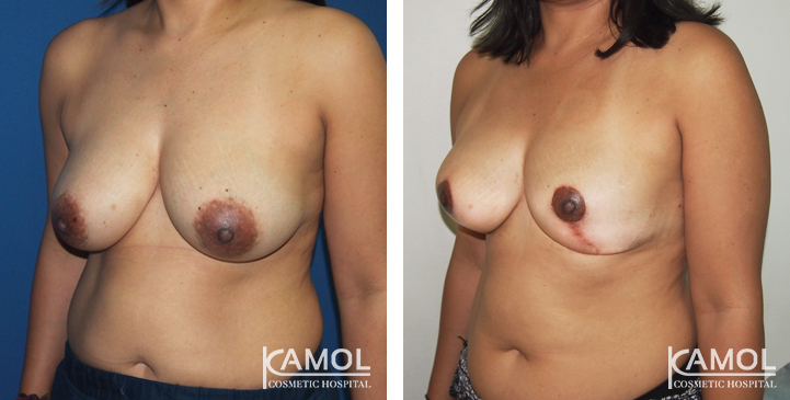 Breast Reduction