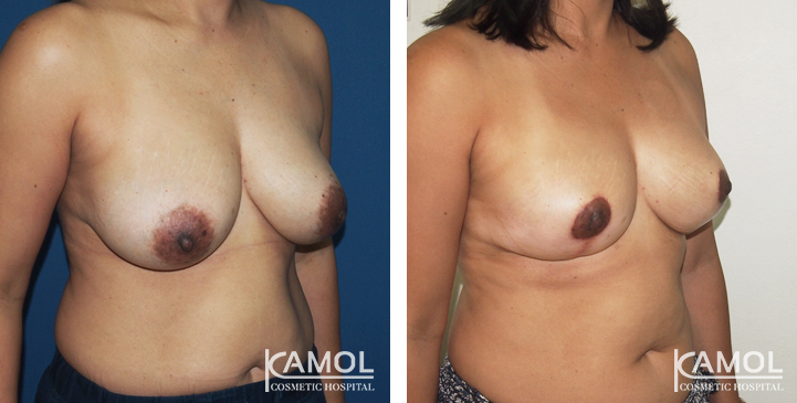 Breast Reduction