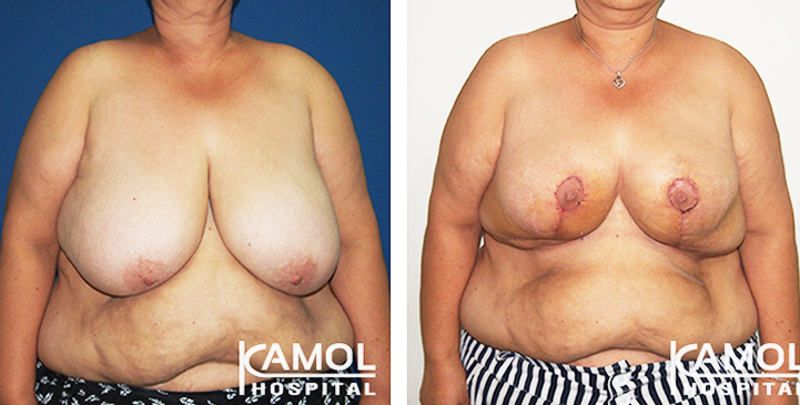 Breast Reduction