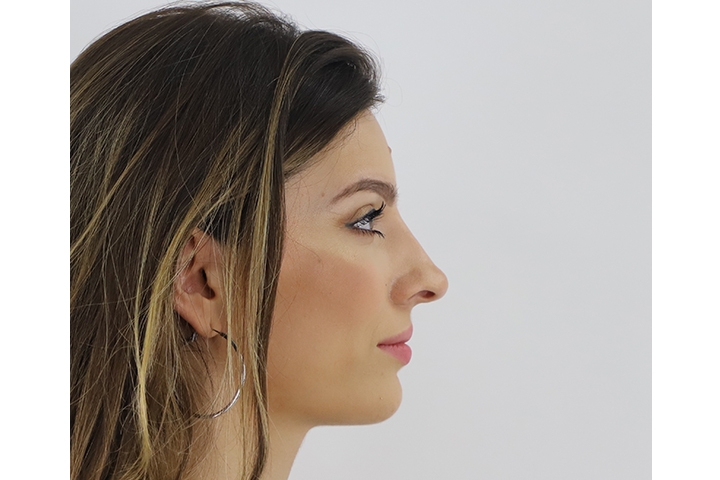 Before rhinoplasty, right side view