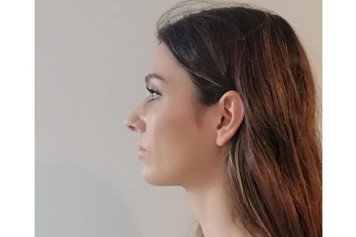 After rhinoplasty 5 days