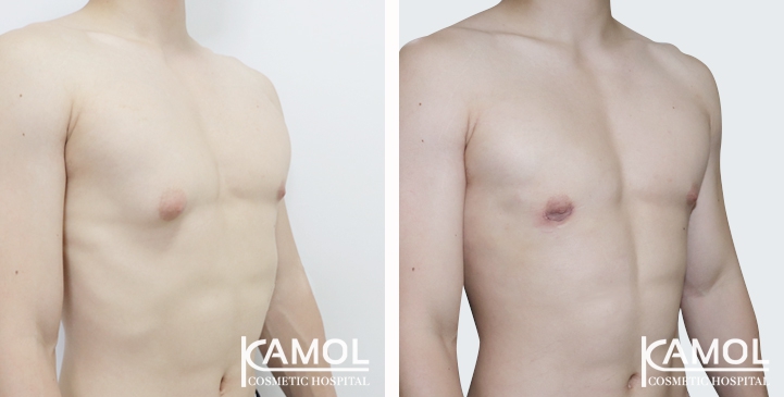 Gynecomastia surgery