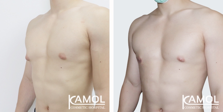 Gynecomastia surgery